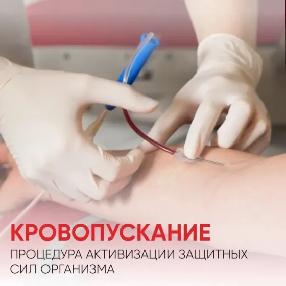Венозное кровопускание — курс оздоровления крови | Алматы Алматы